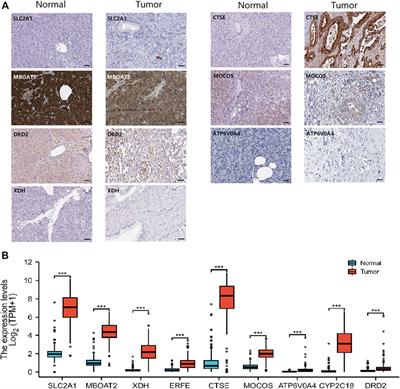 Development and validation of a prognostic prediction model for iron metabolism-related genes in patients with pancreatic adenocarcinoma